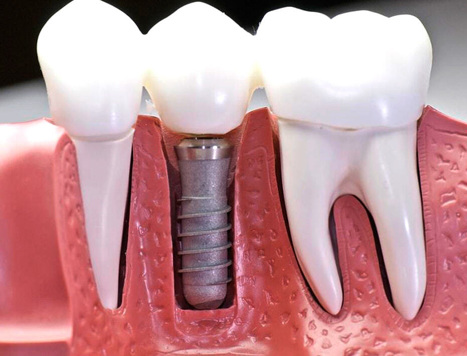 Имплант – это искусственный корень зуба