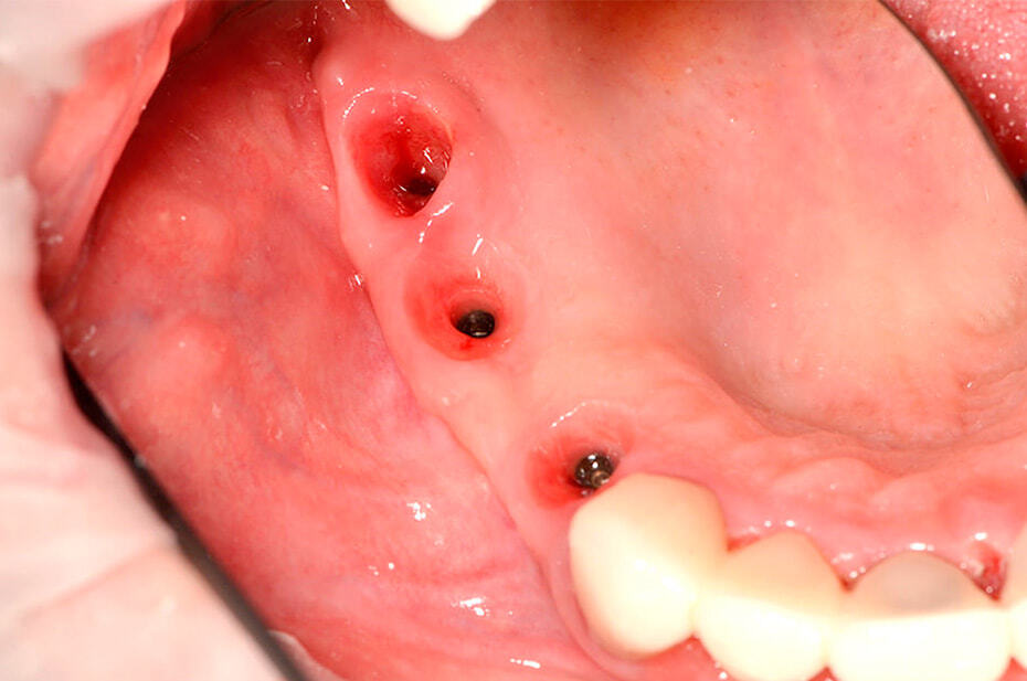 Импланты можно установить и при абсолютной потере зубов